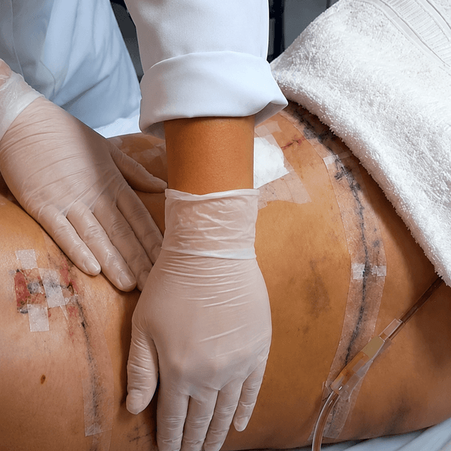 Post-Op Recovery | 4 Sessions at Brazilian Body Sculpting in San Diego, CA