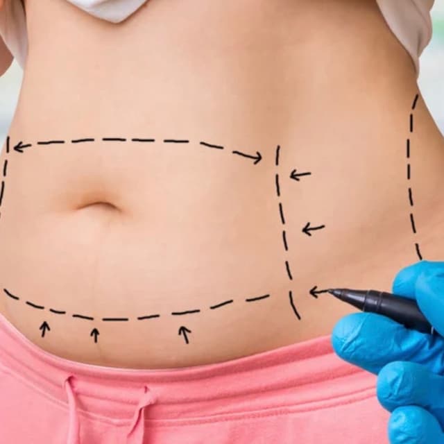 6 Post Op Lymphatic at Brazilian Body Sculpting in San Diego, CA