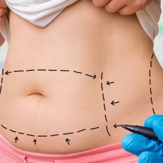 4 Lymphatic Post Op Sessions at Brazilian Body Sculpting in San Diego, CA