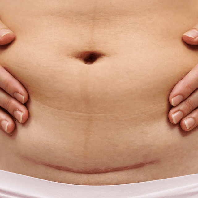 4 Post Partum Recovery at Brazilian Body Sculpting in San Diego, CA